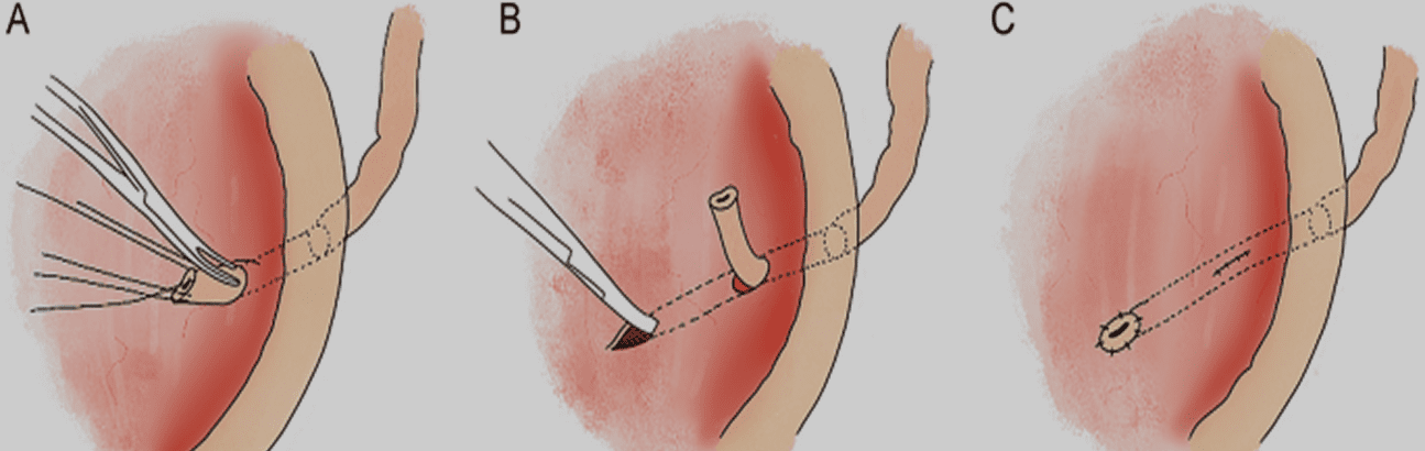 Illustration of stoma formation process on the abdominal wall for urostomy or colostomy surgery