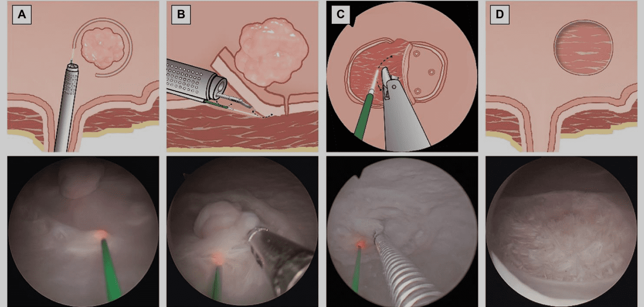 Medical diagram and endoscopic views demonstrating urological or laparoscopic procedure for diagnosis or treatment