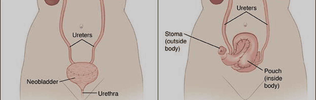 Medical illustration of urinary diversion procedure with stoma and neobladder following bladder removal