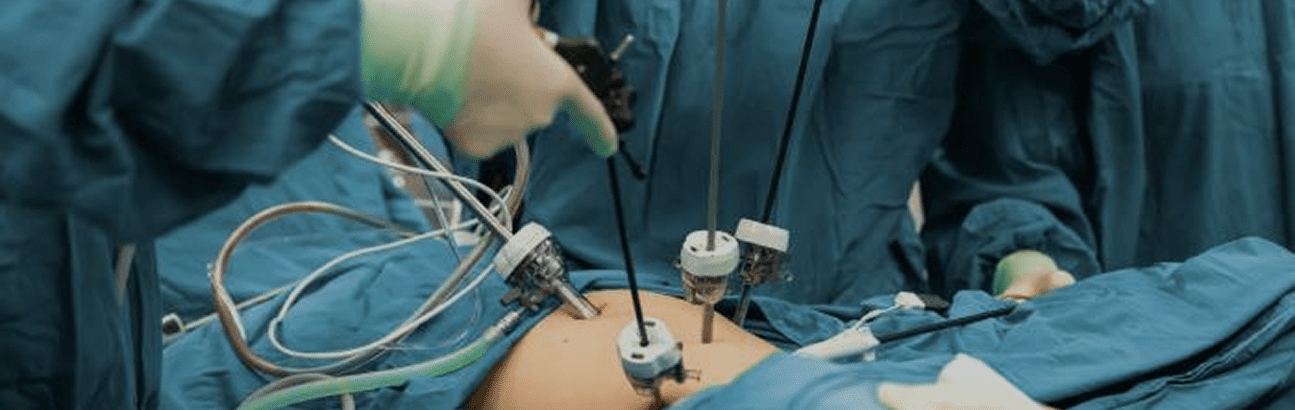 Minimally invasive laparoscopic procedure using surgical ports and camera for abdominal operation.