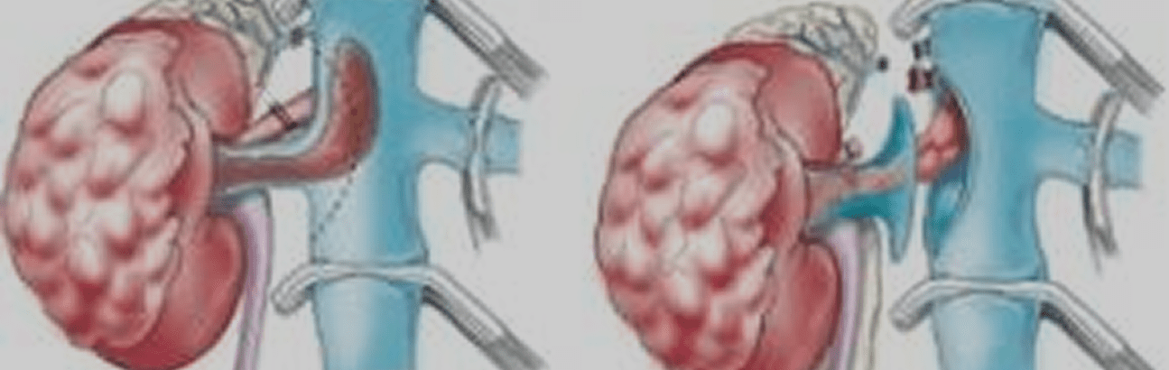 Illustration of polycystic kidney disease and endoscopic or surgical treatment of urinary obstruction